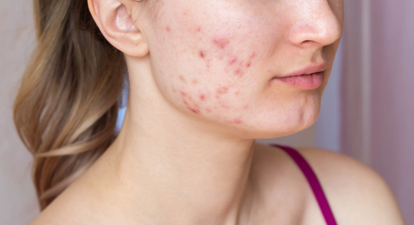 Scar, Acne & Anti-Aging Care