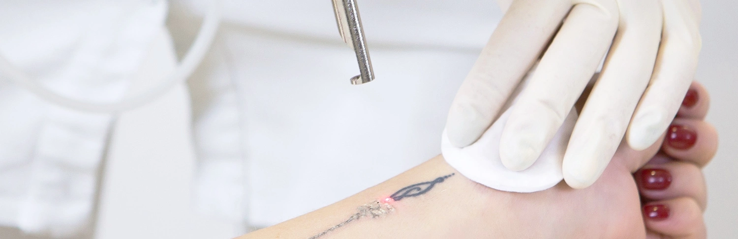 Aluer-Laser Tattoo Removal Calicut