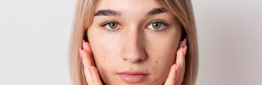 Acne treatment in kerala