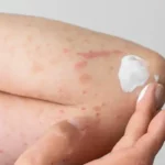 eczema treatment