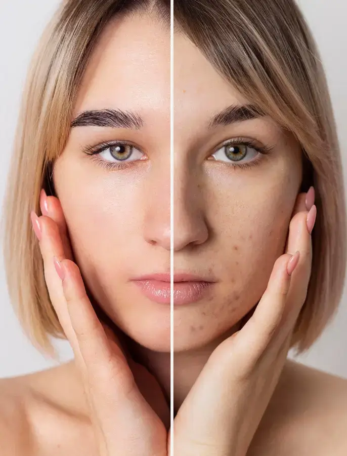 acne scar treatment