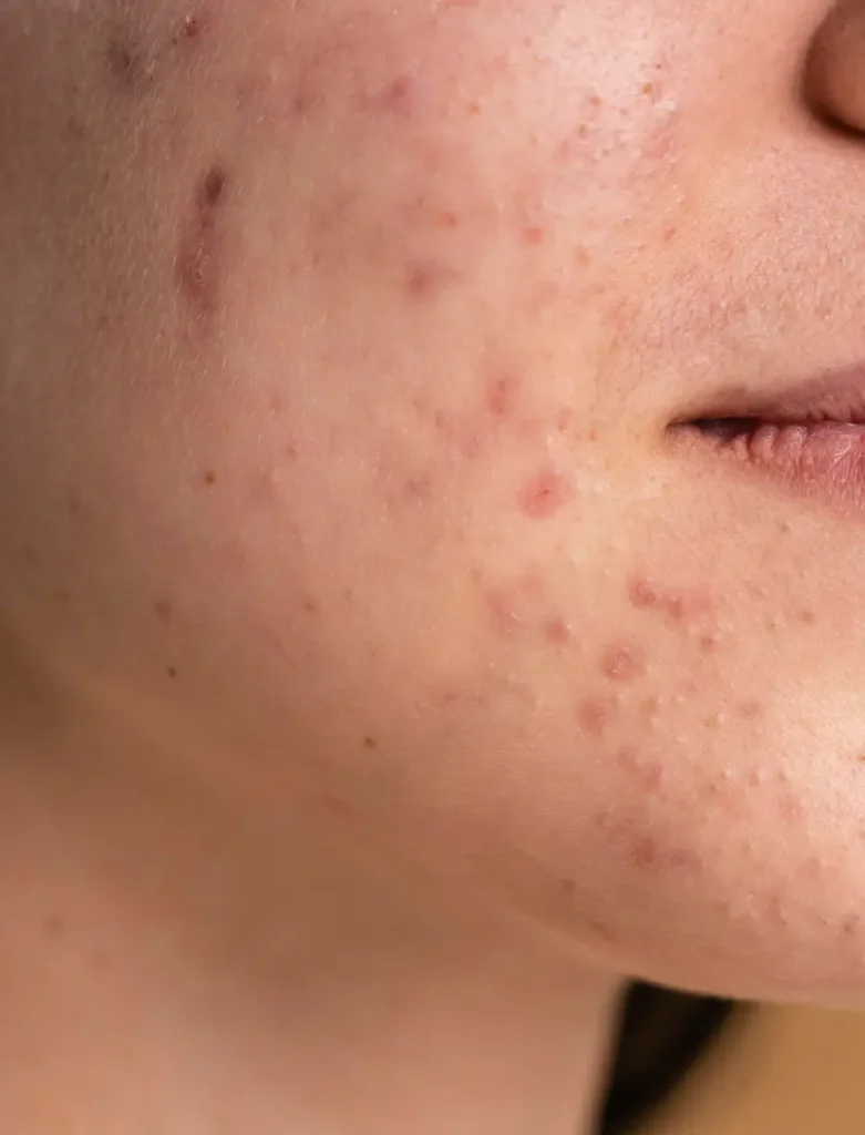 acne scar treatment