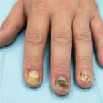 common nail infections
