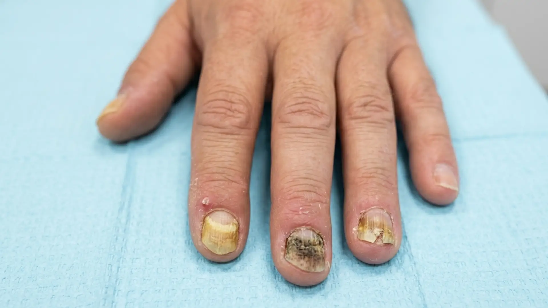common nail infections