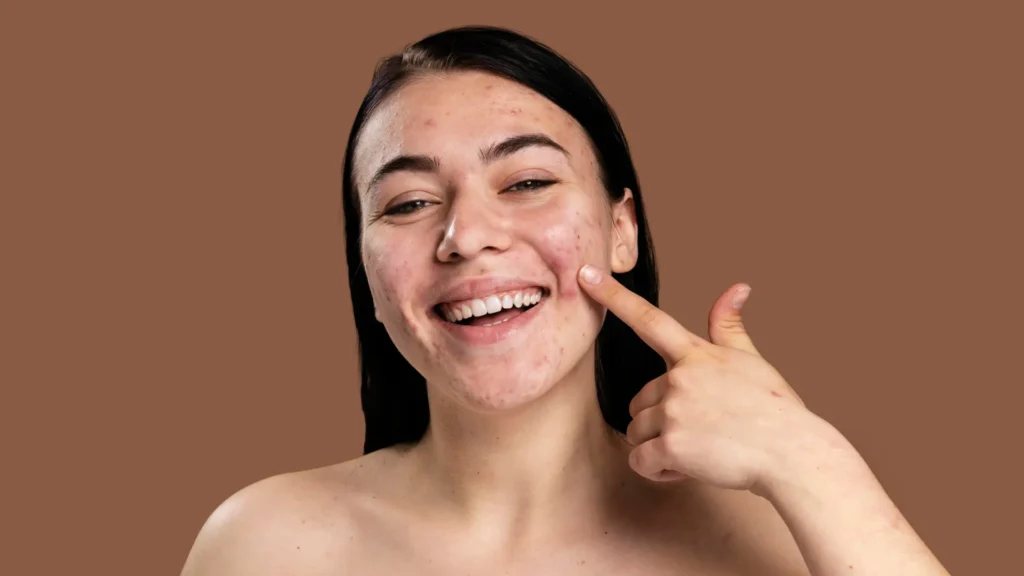 Acne Marks vs Acne Scars