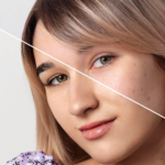 acne marks vs acne scars
