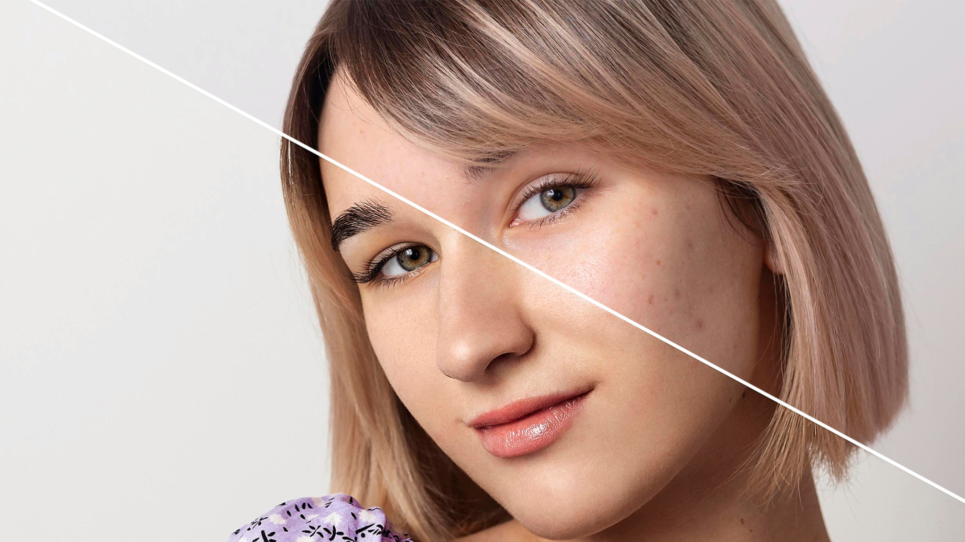 acne marks vs acne scars