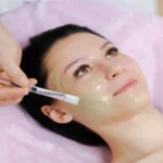 chemical peel treatment