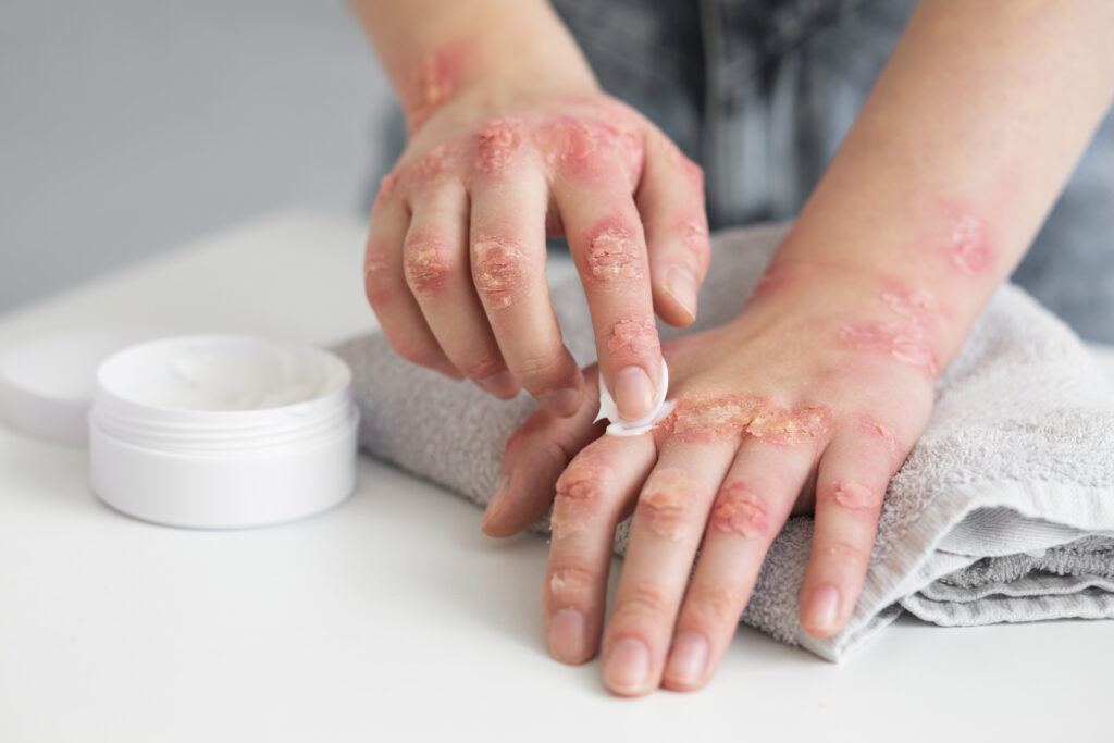 Neurodermatitis
